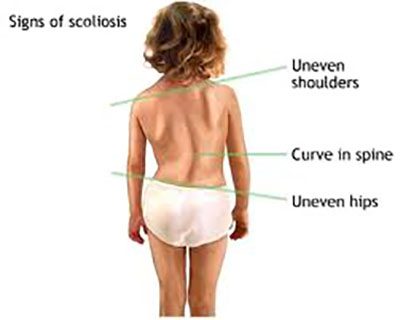 childhood scoliosis